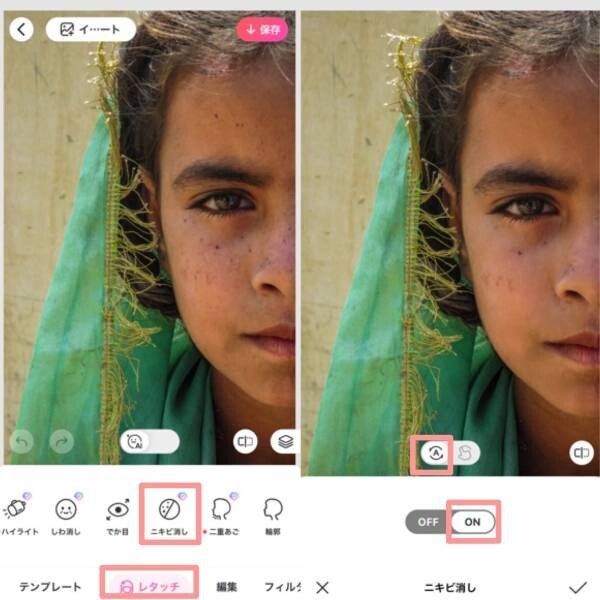 「ニキビ消し」でホクロを消去